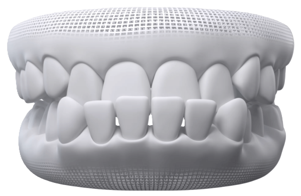 Invisalign treatment for an underbite